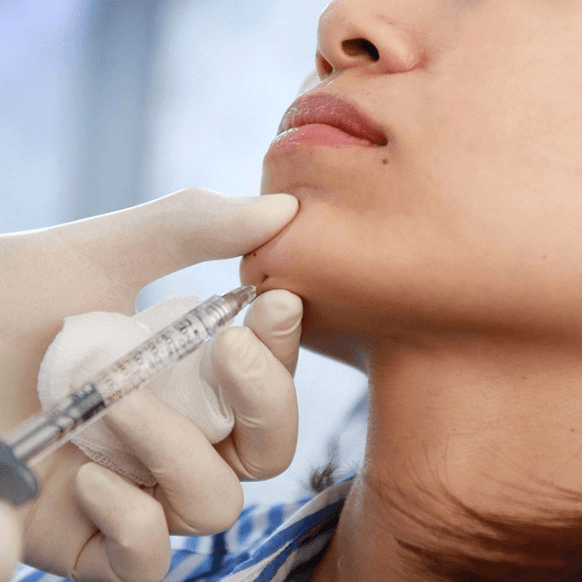 Chin Filler