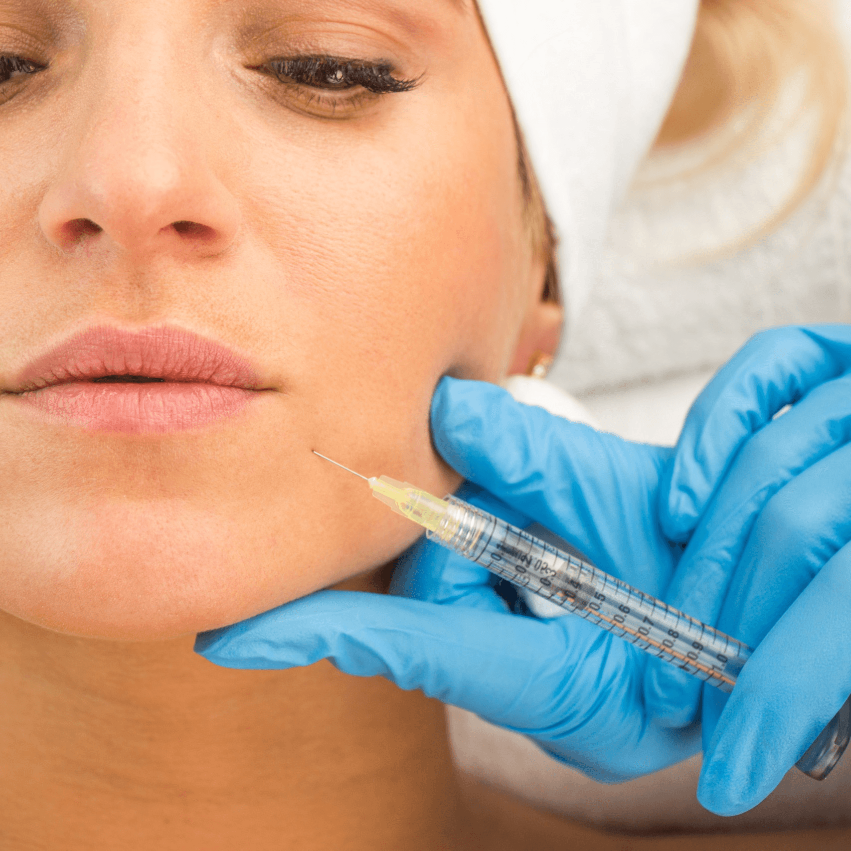 Marionette Line Filler ("Puppet Lines")