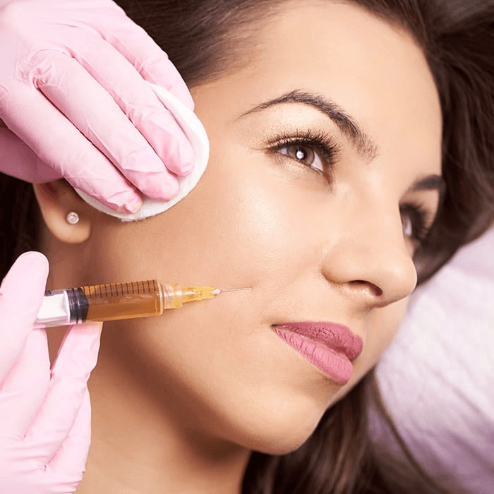 Nasolabial Folds (Smile Lines (NLF))